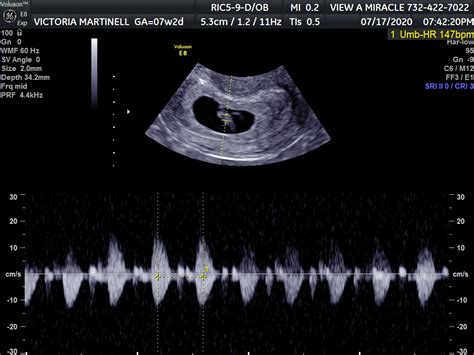 26 Weeks Ultrasound