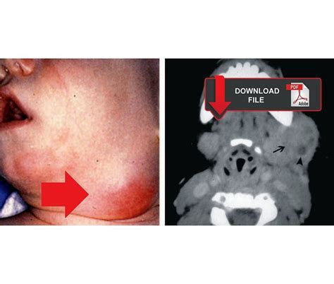 Facial Swelling In A Pediatric Patient Causes Clinical And Radiological Manifestations