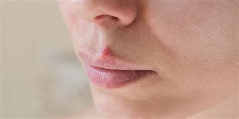 How To Get Rid Of Lip Pimple Useful Tips
