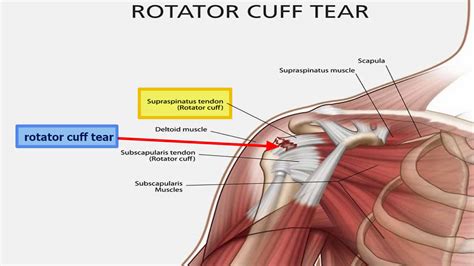 Rotator Cuff Full Thickness Tear Of The Left Shoulder Rotator Cuff My Xxx Hot Girl