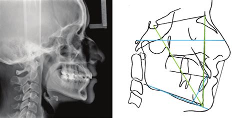 A Radiografía Cefalométrica Postratamiento B Trazado Cefalométrico