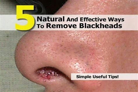Effective Ways To Remove Blackheads Blackheads Blackhead Remover
