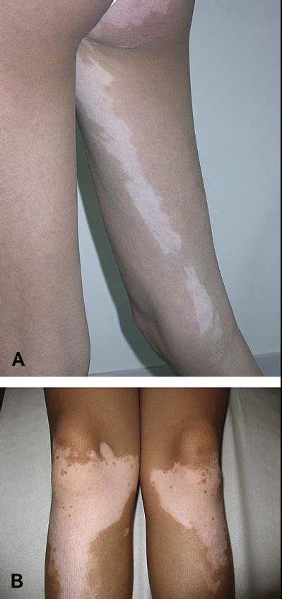 What Is Segmental And Non Segmental Vitiligo Vitiligo Cover