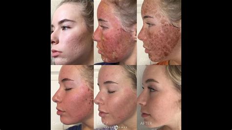 Sciton Profractional Erbium Laser To Deep Acne Scarring On Cheeks Of A