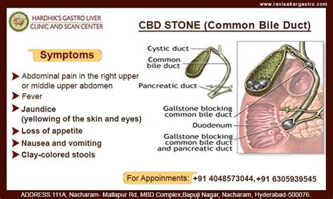 Common Bile Duct Stone Bile Duct Gallbladder Clinic