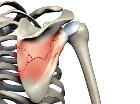 Fractura Corpului Scapulei Cauze Simptome Tratament