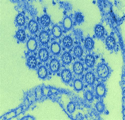Americas Especially Hard Hit By 2009 Swine Flu Study Finds Nbc News