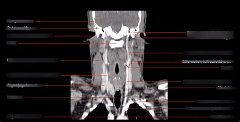 Anatomy Ct Pics Enhanced Neck Diagram Quizlet