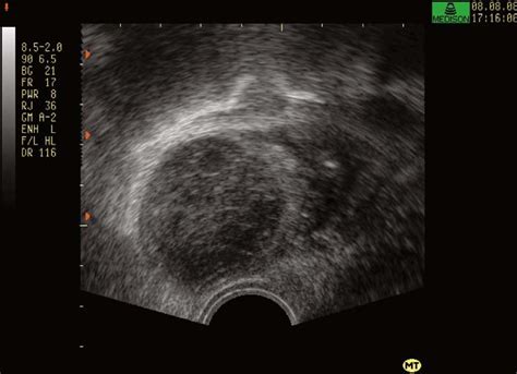 Transvaginal Sonogram Showing A Hemorrhagic Corpus Luteal Cyst With Download Scientific Diagram