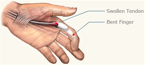 Trigger Finger Definition Etiology Symptoms Diagnosis