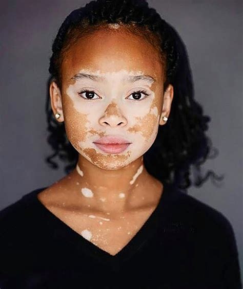 Fotos De Personas Con Vitiligo Que Se Ven Felices Y Bellas
