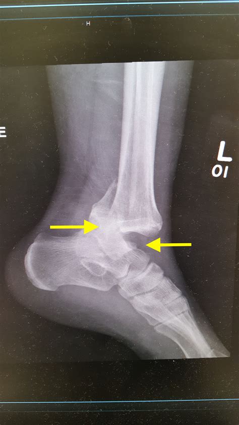 Ankle Pictures Evans Osteotomy Lengthening Lateral Column Flatfoot