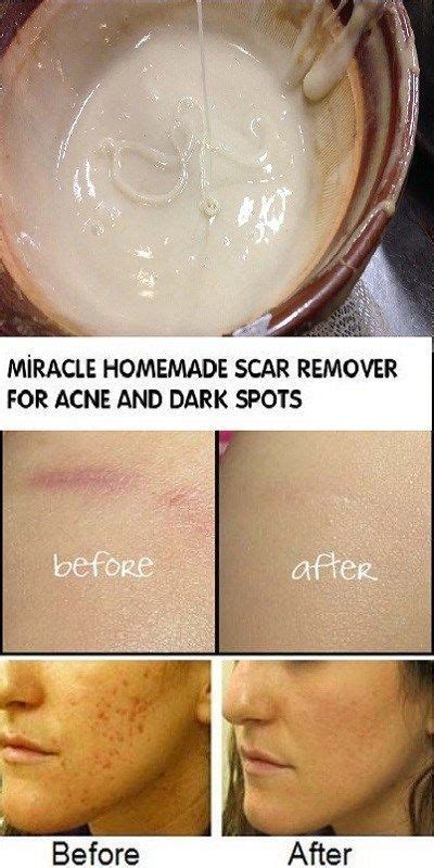 Miracle Homemade Scar Remover For Acne And Dark Spots Acnescars