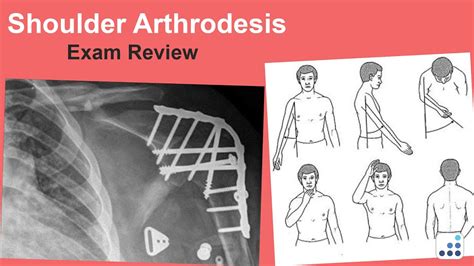 Shoulder Arthrodesis Exam Review Anthony Romeo Md Youtube