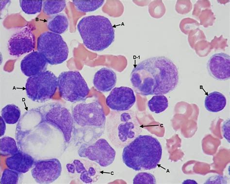 Pleural Fluid A Lymphoma Cells B Lymphocytes C Neutrophils D