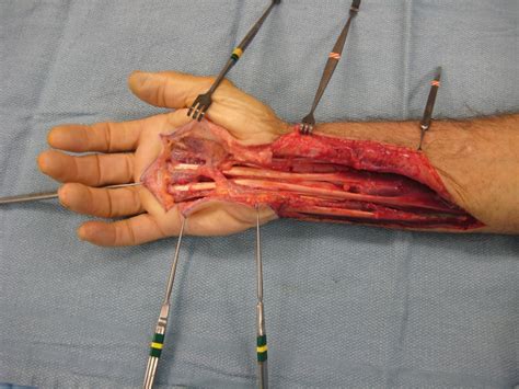 The following picture shows where the pain is felt, on the inside of the elbow, in golfer's elbow because the tendons in the forearm also move your fingers, you can get tendinopathy in your forearm if you are. Infection: Radical flexor synovectomy hand and forearm for granulomatous synovitis