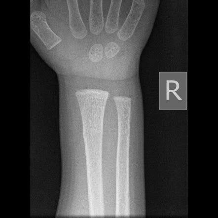 Distal Radius Torus Fracture Image Radiopaedia Org