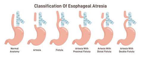 Esophageal Atresia Pass The Nclex Rn With Illustrated Nursing