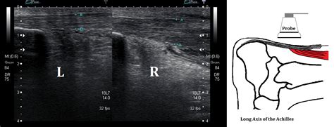 Ultrasound Images Of Achilles Tendinopathy Ankle Foot And Orthotic