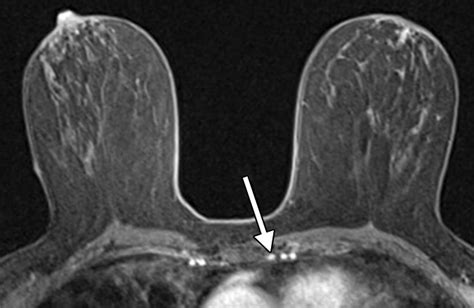 Incidental Internal Mammary Lymph Nodes Visualized On Screening Breast
