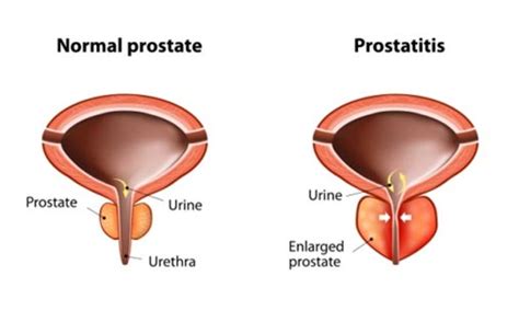 Best Powder Creatine Benign Prostatic Hypertrophy Treatment Drugs Vietsub Prostate Cancer