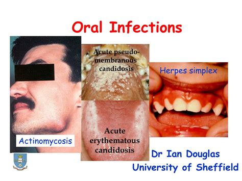 Ppt Oral Infections Powerpoint Presentation Free Download Id3094360