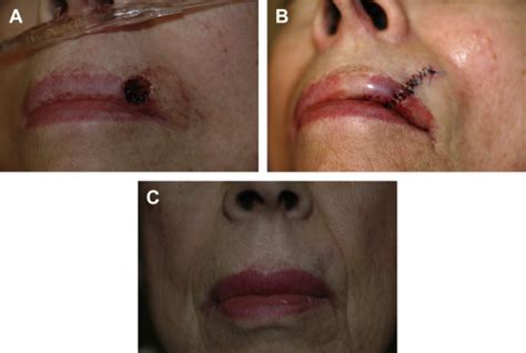 Reconstruction Of Mohs Defects Of The Lips And Chin Facial Plastic