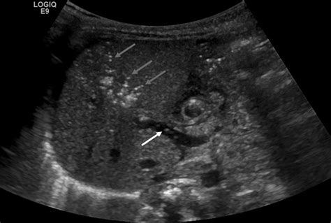 usefulness  abdominal ultrasound  diagnosing necrotising