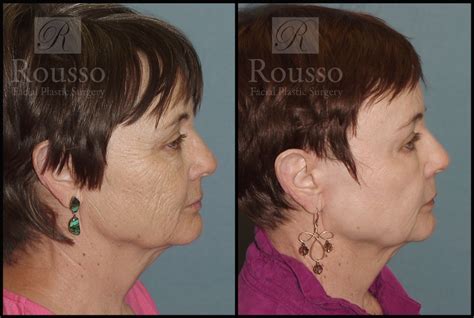Patient 2126625 Chemical Peel Before And After Rousso Adams Facial