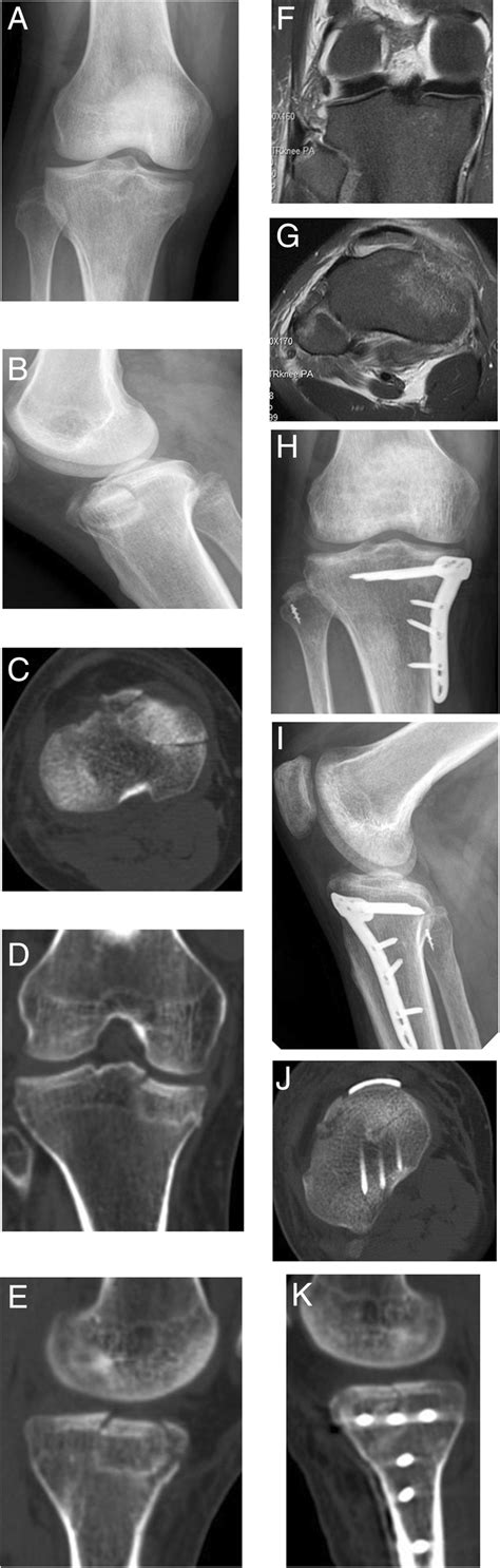 M 36y Anterior Medial Tibial Plateau Fracture With Plc Injury A B