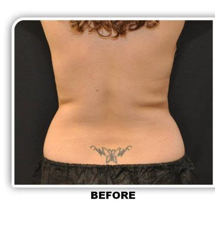 Patient 4869 Coolsculpting Before And After Photos La Jolla Plastic