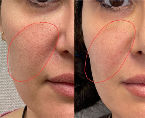 Morpheus 8 Treatment For Acne Scars And Wrinkles Los Angeles Glendale