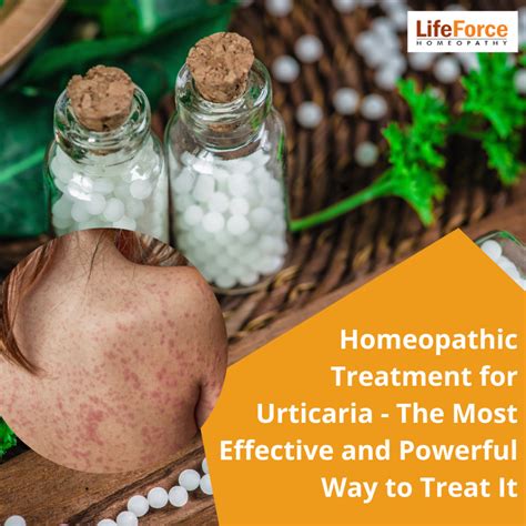 Homeopathic Treatment For Urticaria The Most Effective And Powerful