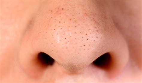 How To Get Rid Of Blackheads—5 Tips For Guys And Tiege Hanley