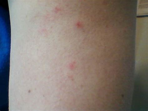 Skin Rash That Looks Like Pimples And Bumps Itches Alot In Evening And