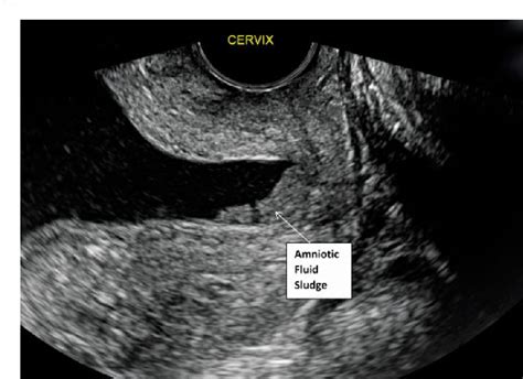 Figure 1 From The Independent Association Of A Short Cervix Positive