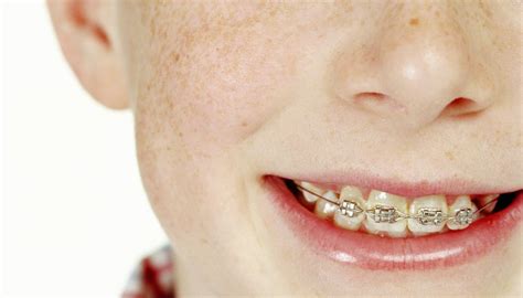 What To Do If Kids Need Braces And You Cant Afford Them How To Adult