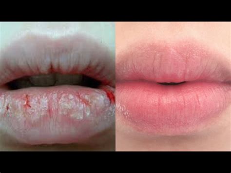 What Is The Best Chapstick For Extremely Chapped Lips