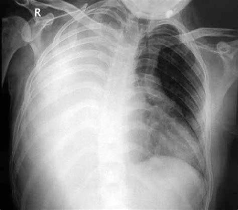 Chest X Ray Showing The Massive Pleural Effusion On The Right Side That