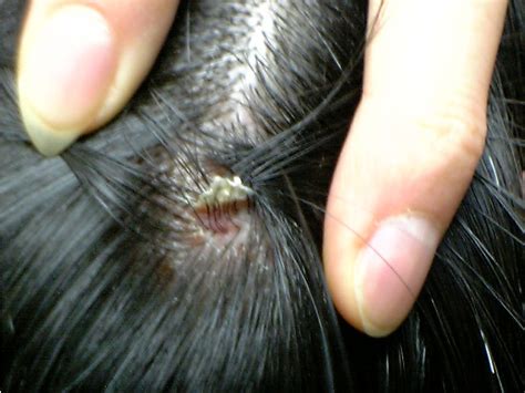 Scalp Scabs Flickr Photo Sharing