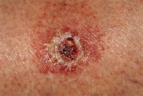 Basal Cell Carcinoma On Leg Of Elderly Woman Photograph By Dr P
