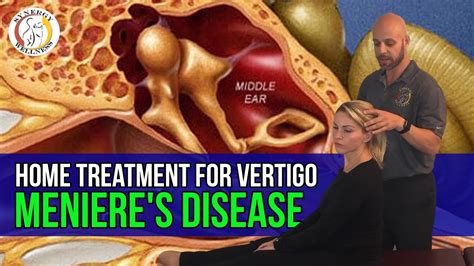Home Treatment For Vertigo Bppv Menieres Disease Youtube