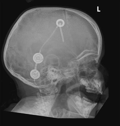 Ventriculoperitoneal Shunt Radiology Reference Article Radiopaedia Org