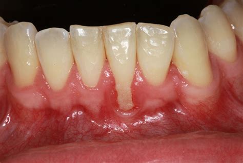 Gum Recession Causes And Treatment French Dental Services Dubai