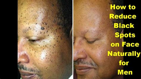 Black Spot On Face How To Remove Dark Spots From Face Naturally