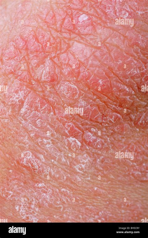 Skin Disorder High Resolution Stock Photography And Images Alamy