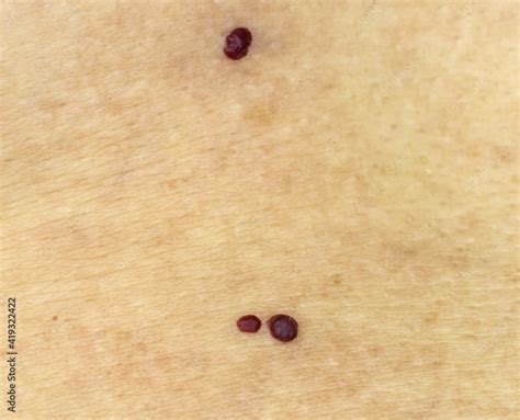 Red Moles On Caucasian Skin Cherry Angioma Senile Angioma Stock Foto