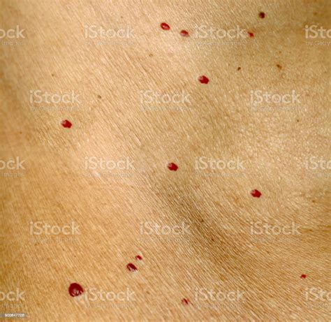 Angioma On The Skin Red Moles On The Body Many Birthmarks Zdjęcia