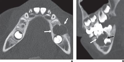 Figure 1—6 From Focal Benign Disorders Of The Pediatric Mandible With