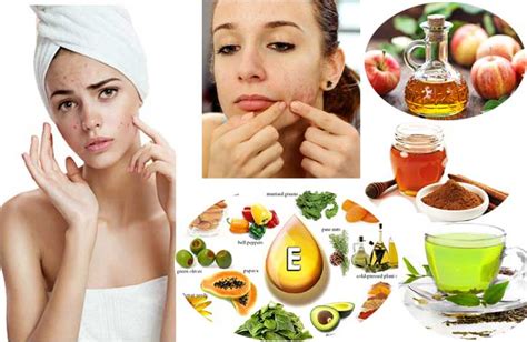 Home Remedies For Teenage Pimples At Home Home Health Beauty Tips
